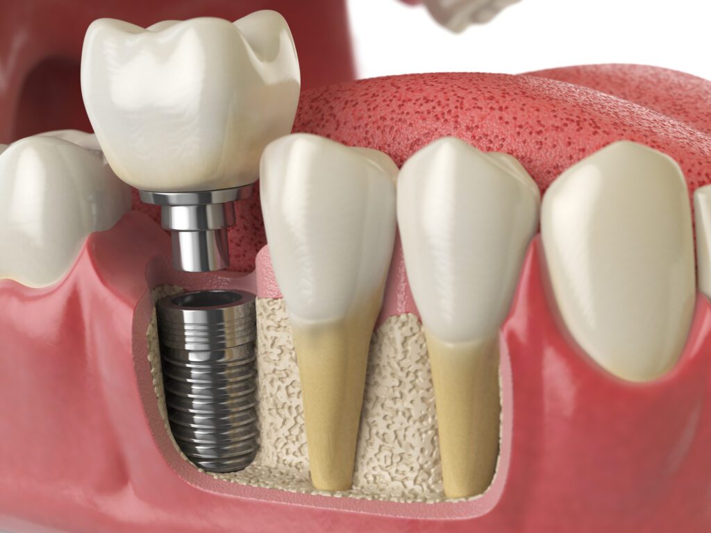 Dental Implants in Allen, TX