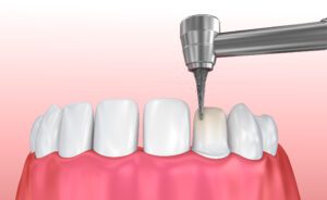 The Porcelain Veneers Process in Allen, TX