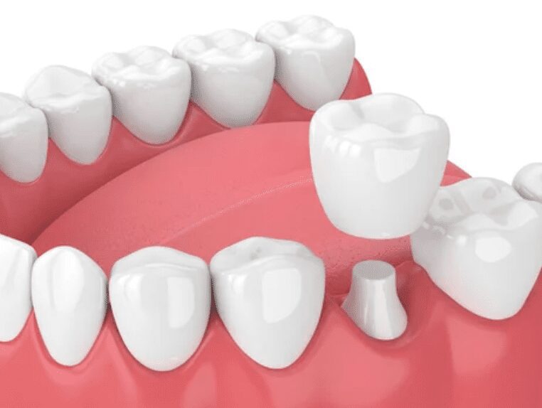 How Dental Crowns Help
