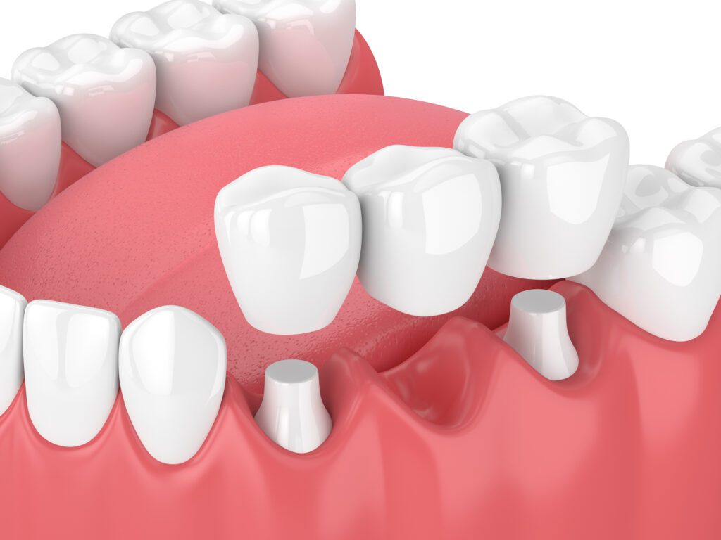 dental bridge in Allen, TX