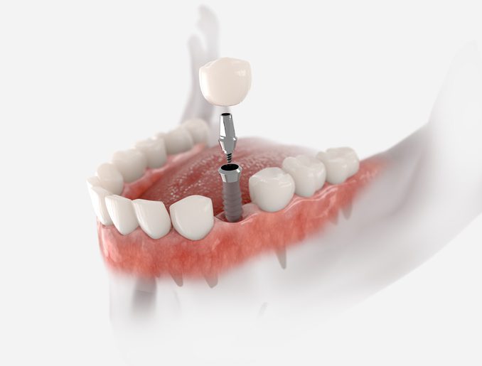 single dental implant in Allen, TX