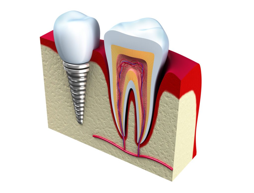 benefits of dental implants in Allen, TX